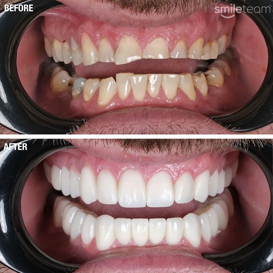 Smile Team Turkey - (Dental Implants, Crowns, Veneers & Teeth Whitening)