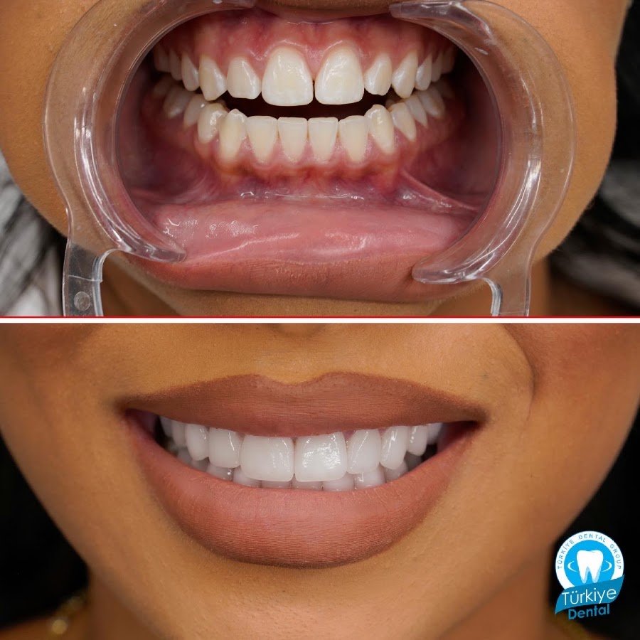 Türkiye Dental | Dental Implant | Hollywood Smile