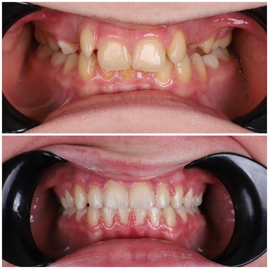 Butik Dental Ortodonti Uzmanı Dr.Yusuf Ozan Topçu Diş Hekimi Dt. Özge Topçu İzmir Ortodonti - Şeffaf Plak (İnvısalıgn) Tedavi