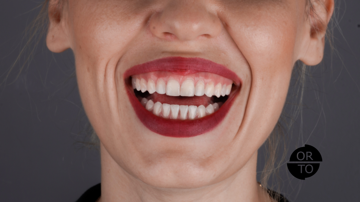 Ortodonti Uzmanı Dr. Halil Toros Bingöl - İzmir-Şeffaf Plak (İnvisalign) Ortodontik Tedavi