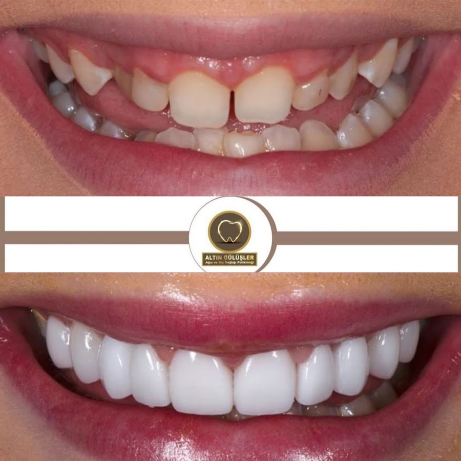 Golden Smile Dent